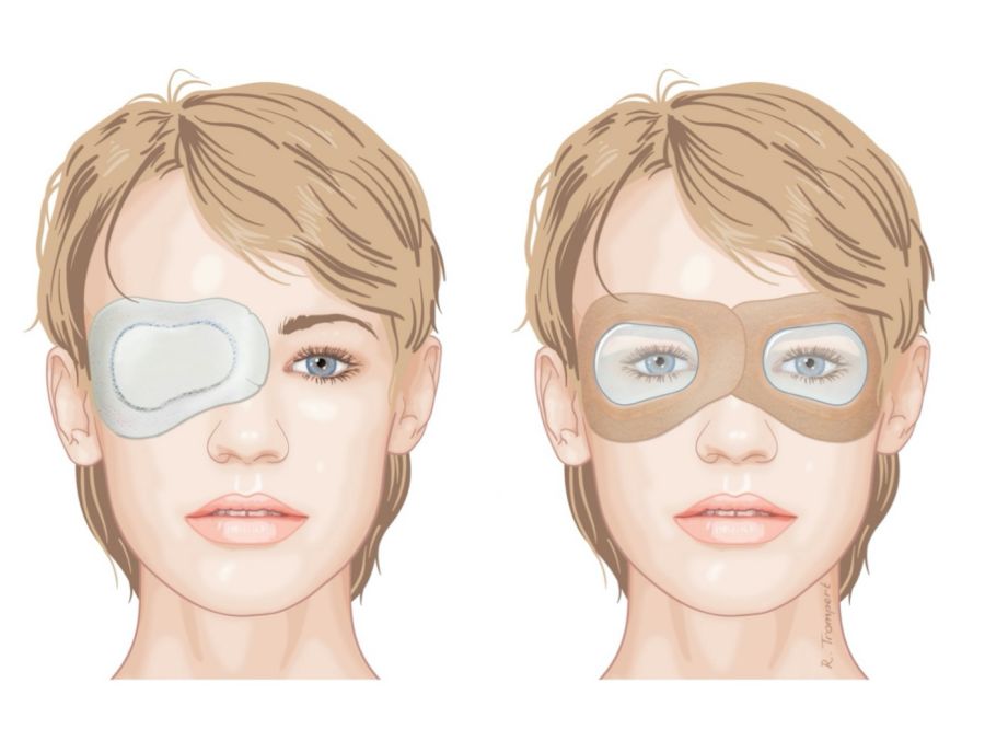 "in ISBCS, transparant eye patches are used (right picture) instead of a non-transparant eye patch in DSBCS (left picture)"